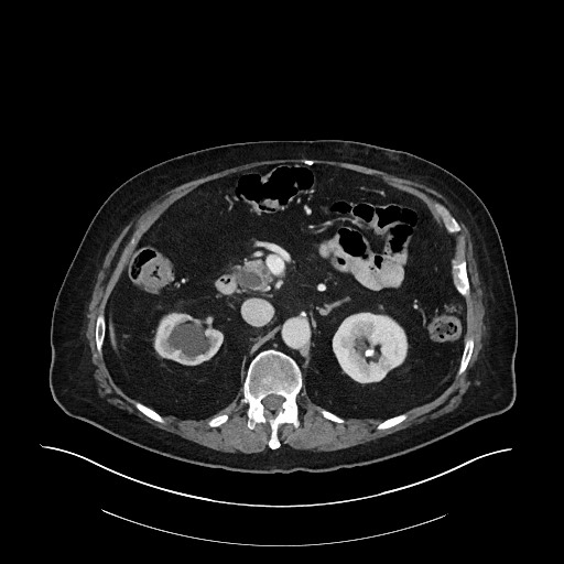 Ampullary adenocarcinoma (Radiopaedia 59373-66734 C 59).jpg