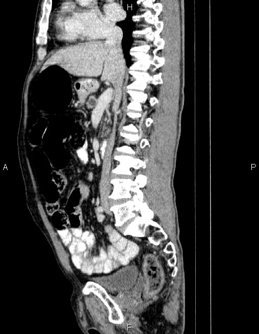 Ampullary adenocarcinoma (Radiopaedia 86093-102032 D 43).jpg