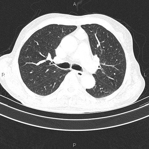 Ampullary adenocarcinoma (Radiopaedia 86093-102033 Axial lung window 29).jpg