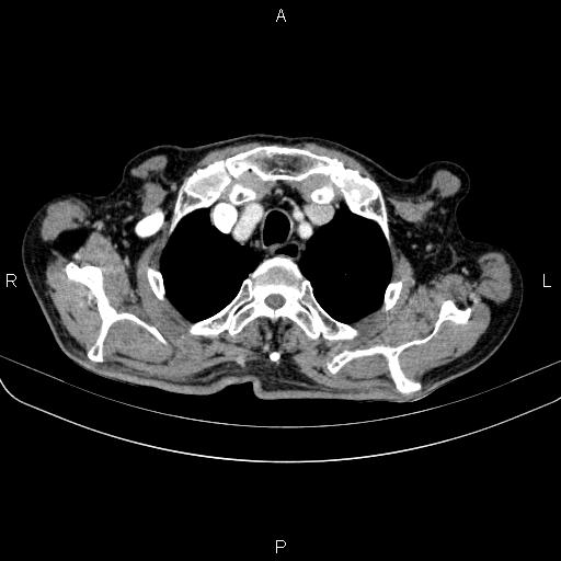 File:Ampullary adenocarcinoma (Radiopaedia 86093-102033 B 17).jpg