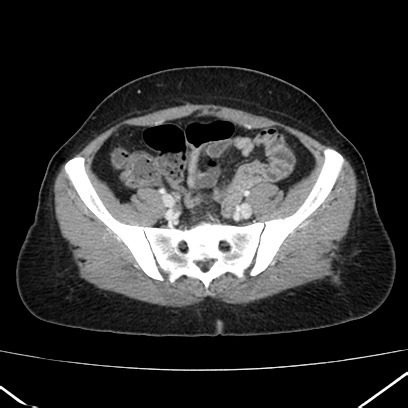 Ampullary tumor (Radiopaedia 22787-22816 C 53).jpg
