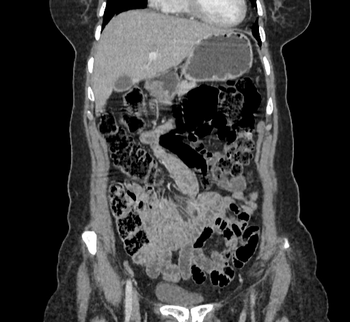 Ampullary tumor (Radiopaedia 60333-67998 B 21).jpg