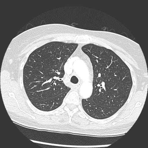 File:Amyloidosis - bronchial and diffuse nodular pulmonary involvement (Radiopaedia 60156-67745 Axial lung window 25).jpg