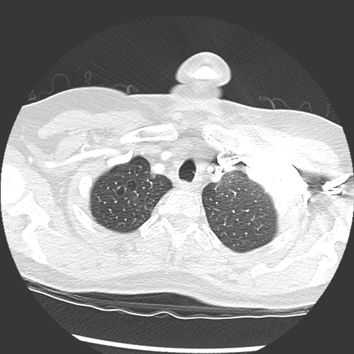 Amyloidosis - bronchial and diffuse nodular pulmonary involvement (Radiopaedia 60156-67745 Axial lung window 7).jpg