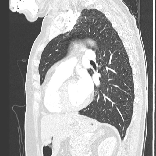 Amyloidosis - bronchial and diffuse nodular pulmonary involvement (Radiopaedia 60156-67745 Sagittal lung window 57).jpg