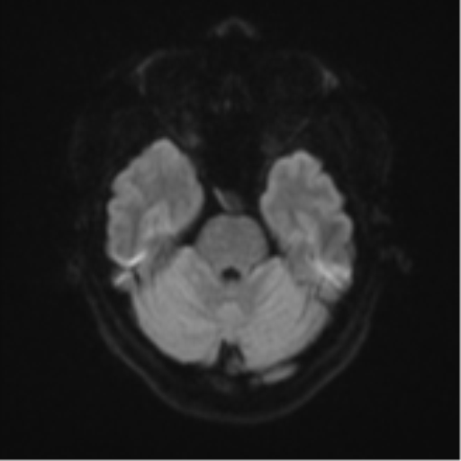 Anaplastic astroblastoma (Radiopaedia 55666-62194 Axial DWI 37).png