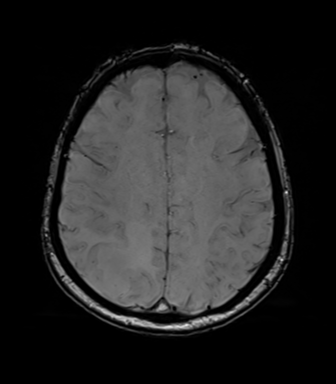 Anaplastic astrocytoma (Radiopaedia 86943-103160 Axial SWI 63).png