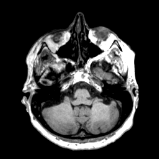 Anaplastic astrocytoma IDH wild-type (pseudoprogression) (Radiopaedia 42209-45277 Axial T1 28).png
