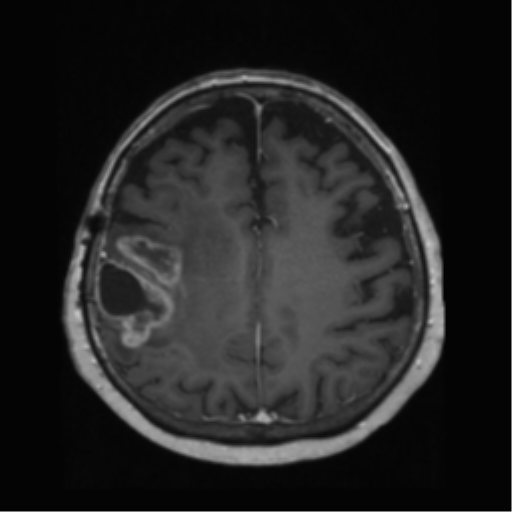 File:Anaplastic astrocytoma IDH wild-type (pseudoprogression) (Radiopaedia 42209-45278 Axial T1 C+ 107).png