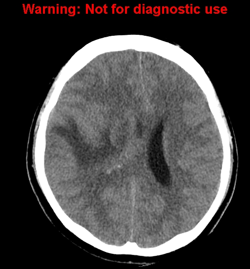 File:Anaplastic ganglioglioma (Radiopaedia 44921-48815 Axial non-contrast 17).jpg