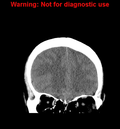 File:Anaplastic ganglioglioma (Radiopaedia 44921-48815 Coronal non-contrast 10).jpg