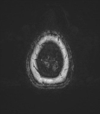 Anaplastic oligodendroglioma (Radiopaedia 83500-98599 L 86).png