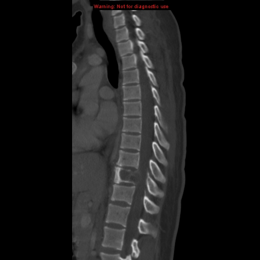 File:Aneurysmal bone cyst (Radiopaedia 9419-10102 Sagittal bone window 7).jpg