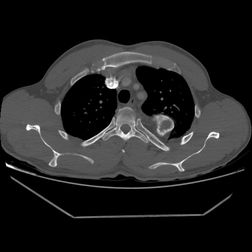 Aneurysmal bone cyst - rib (Radiopaedia 82167-96220 Axial bone window 84).jpg