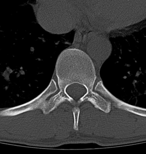 Aneurysmal bone cyst T11 (Radiopaedia 29294-29721 Axial bone window 30).jpg