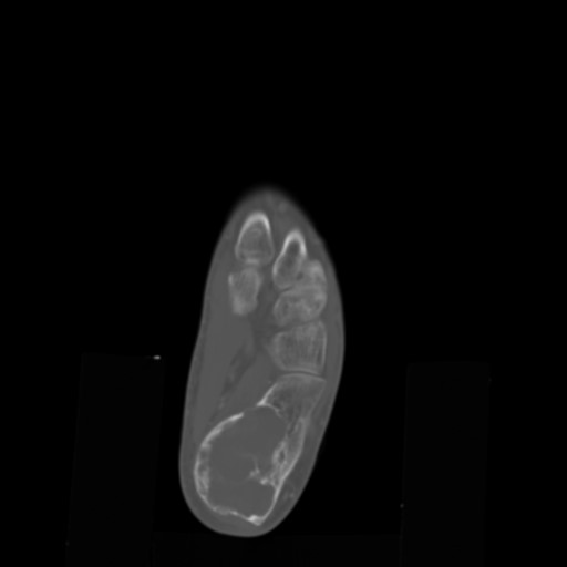 File:Aneurysmal bone cyst of the calcaneus (Radiopaedia 60669-68421 Axial bone window 12).jpg