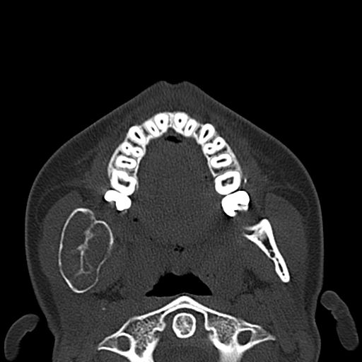 Aneurysmal bone cyst of the mandible (Radiopaedia 43280-46601 Axial bone window 43).jpg