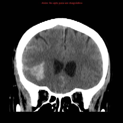 File:Aneurysmal subarachnoid hemorrhage (Radiopaedia 24740-24997 Coronal non-contrast 13).jpg