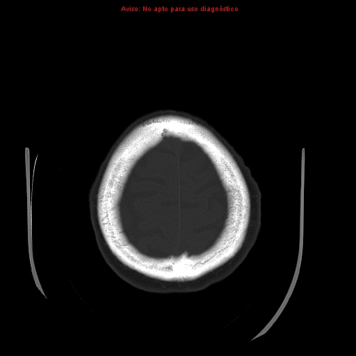 File:Aneurysmal subarachnoid hemorrhage (Radiopaedia 24740-24997 bone window 32).jpg