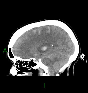 File:Aneurysmal subarachnoid hemorrhage with intra-axial extension (Radiopaedia 84371-99699 B 20).jpg