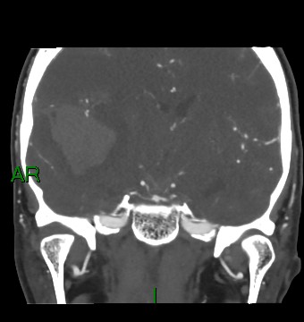 Aneurysmal subarachnoid hemorrhage with intra-axial extension (Radiopaedia 84371-99732 C 53).jpg