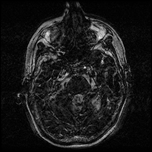 Angioinvasive aspergillosis in the pituitary fossa (Radiopaedia 39676-42010 Ax 3D FIESTA VOLUME 30).png
