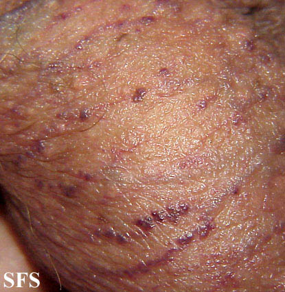 Angiokeratoma Of The Scrotum (Dermatology Atlas 7).jpg