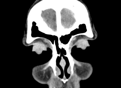 Angular dermoid cyst (Radiopaedia 88967-105790 Coronal non-contrast 12).jpg