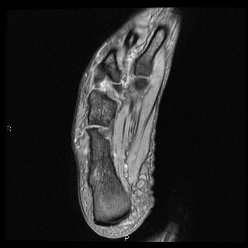 Ankle ganglion cyst (Radiopaedia 62809-71162 Axial Gradient Echo 14).jpg