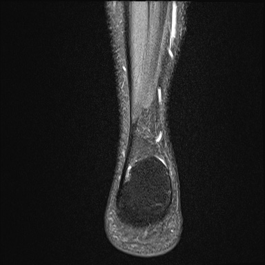 File:Ankle syndesmotic injury (Radiopaedia 69066-78837 Coronal PD fat sat 7).jpg