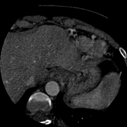 Anomalous left coronary artery from the pulmonary artery (ALCAPA) (Radiopaedia 40884-43586 A 84).jpg