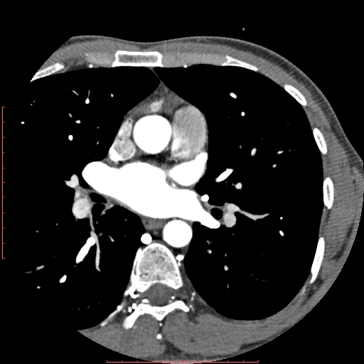 Anomalous left coronary artery from the pulmonary artery (ALCAPA) (Radiopaedia 70148-80181 A 58).jpg