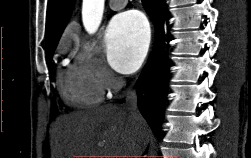 File:Anomalous left coronary artery from the pulmonary artery (ALCAPA) (Radiopaedia 70148-80181 C 78).jpg