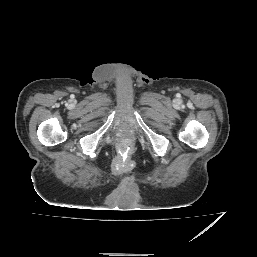 Anorectal carcinoma (Radiopaedia 44413-48064 A 59).jpg