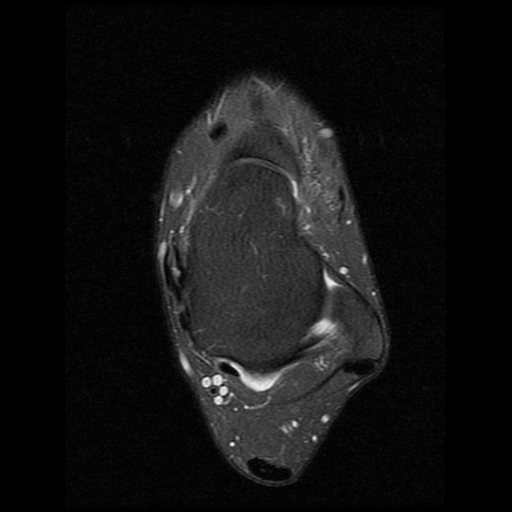 File:Anterior calcaneal process fracture (Radiopaedia 74654-85611 Axial PD fat sat 10).jpg