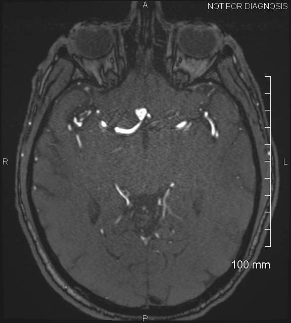Anterior cerebral artery aneurysm (Radiopaedia 80683-94127 Axial MRA 107).jpg