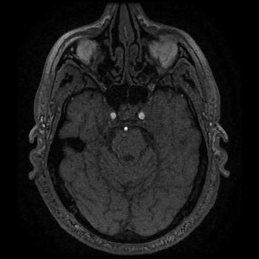 Anterior cerebral artery infarction (Radiopaedia 46794-51323 Axial MRA 47).jpg