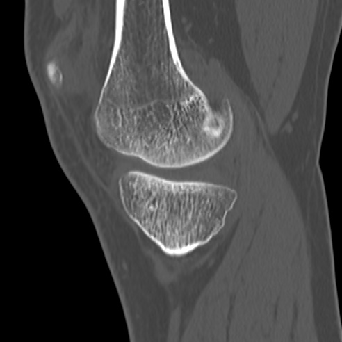 File:Anterior cruciate ligament avulsion fracture (Radiopaedia 58939-66194 Sagittal bone window 29).jpg