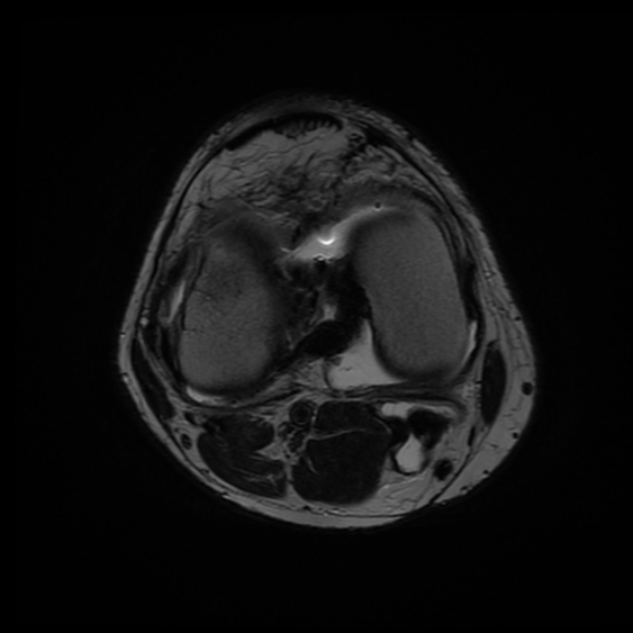 File:Anterior cruciate ligament graft tear and bucket-handle tear of medial meniscus (Radiopaedia 75867-87255 Axial T2 10).jpg