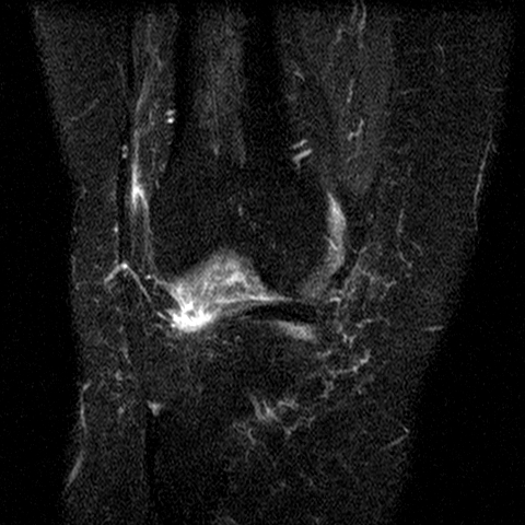 File:Anterior cruciate ligament mucoid degeneration (Radiopaedia 60853-68633 Coronal STIR 13).jpg
