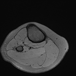 File:Anterior cruciate ligament rupture and posteromedial corner injury (Radiopaedia 67338-76723 Axial 37).jpg