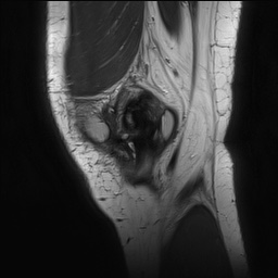 Anterior cruciate ligament rupture with Segond fracture (Radiopaedia 69043-78806 Sagittal PD 28).jpg