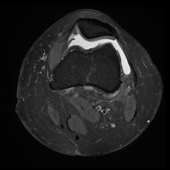 File:Anterior cruciate ligament tear, Wrisberg rip and bucket-handle tear of medial meniscus (Radiopaedia 75872-87266 Axial PD fat sat 21).jpg