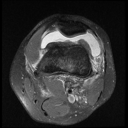 File:Anterior cruciate ligament tear (Radiopaedia 61500-69462 Axial PD fat sat 3).jpg