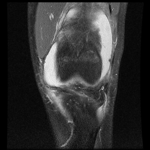 File:Anterior cruciate ligament tear (Radiopaedia 61500-69462 Coronal PD fat sat 6).jpg