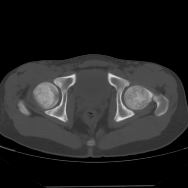 Anterior inferior iliac spine avulsion fracture (Radiopaedia 49469-54627 Axial bone window 43).jpg