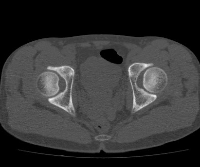 Anterior inferior iliac spine avulsion fracture (Radiopaedia 81312-94999 Axial bone window 53).jpg
