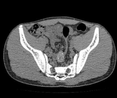 Anterior inferior iliac spine avulsion fracture (Radiopaedia 81312-94999 Axial non-contrast 35).jpg