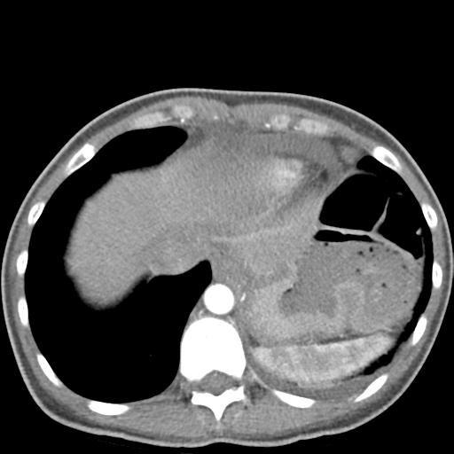 Anterior mediastinal lymphoma (Radiopaedia 29556-30061 C 47).jpg