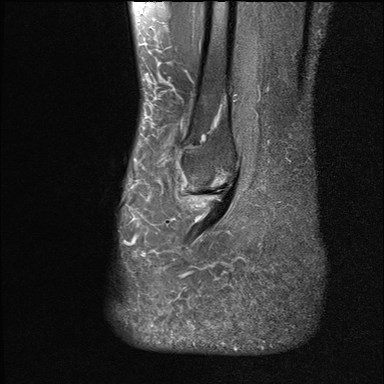 File:Anterior talofibular ligament injury - rupture with soft-tissue impingement (Radiopaedia 38765-40928 Sagittal PD fat sat 18).jpg